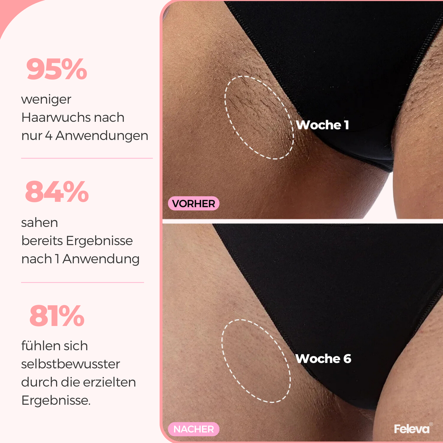 LumiPro® IPL Haarentferner