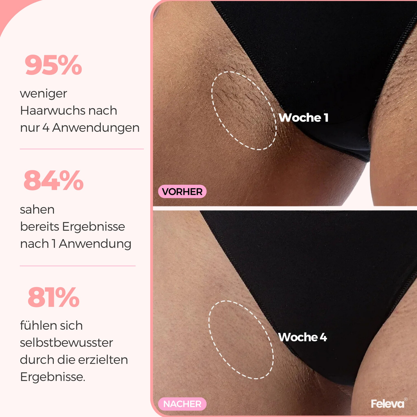 LumiPro® IPL Haarentferner