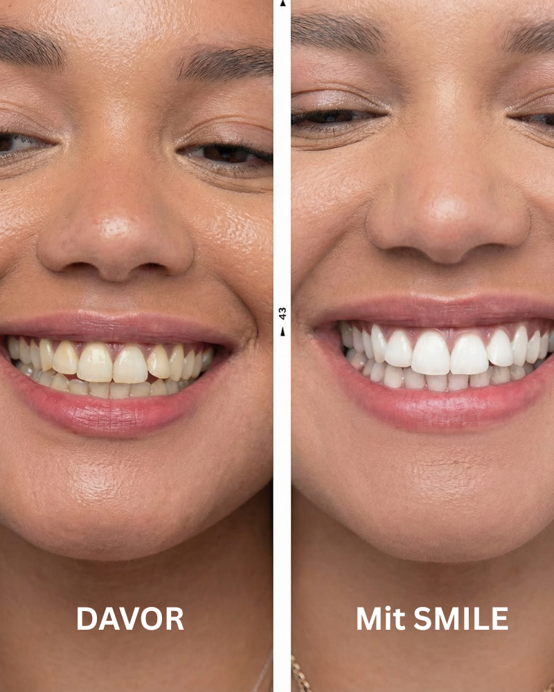 SMILE® - Sofort Weiße Zähne